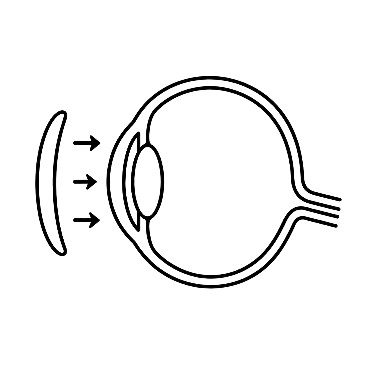 Cross-section of an eye showing an Ortho-K contact lens reshaping the cornea